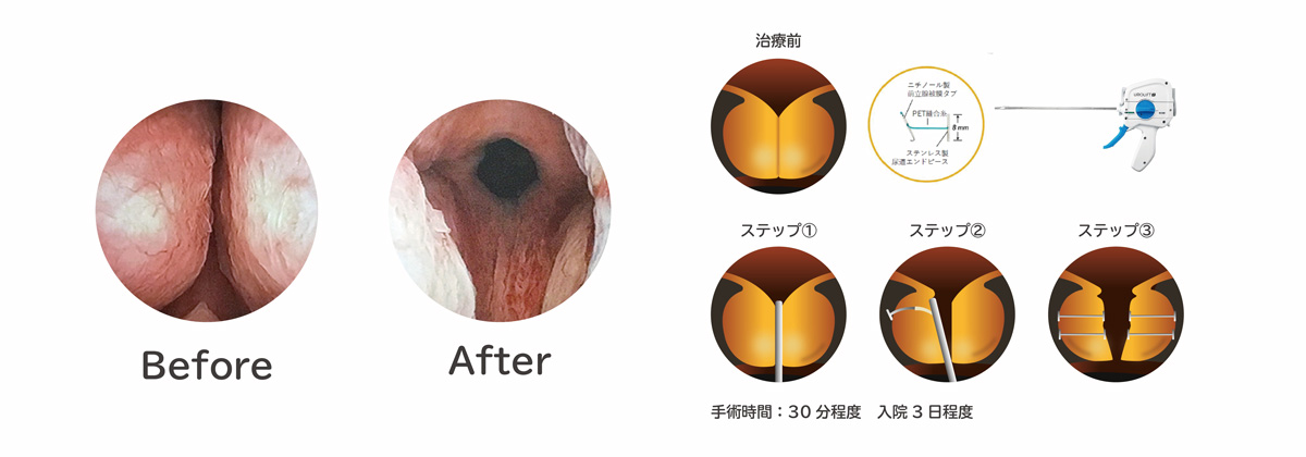 経尿道的前立腺吊り上げ術(ウロリフト)